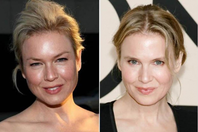 Renee Zellweger Before and After