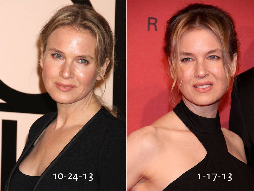 Renee Zellweger Before and After